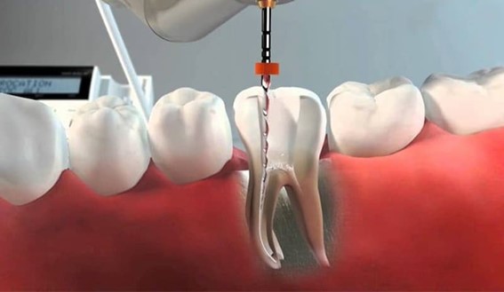 Tratamiento de endodoncia multirradicular con Dental Zafra