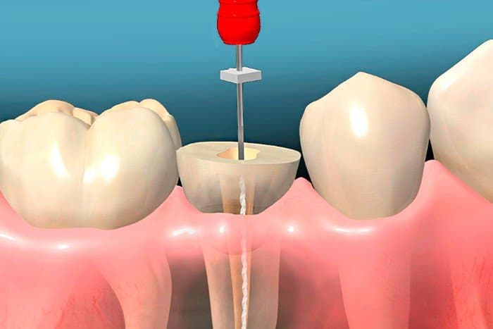 Tratamiento de endodoncia unriradicular con Dental Zafra