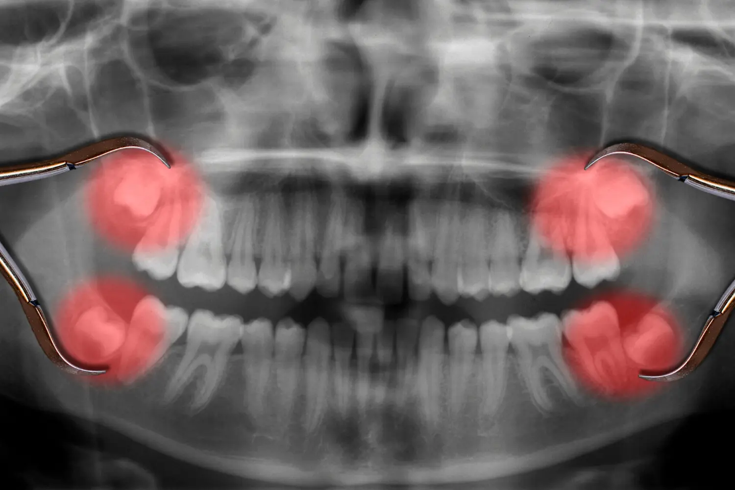 Extracción oral compleja