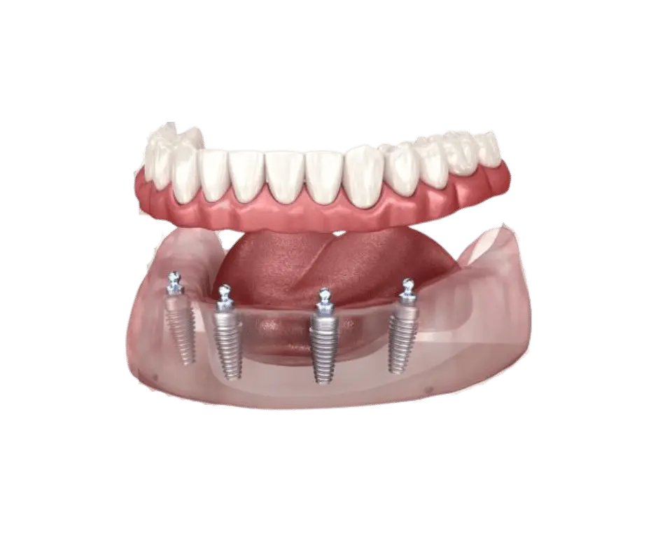 Prótesis dental híbrida