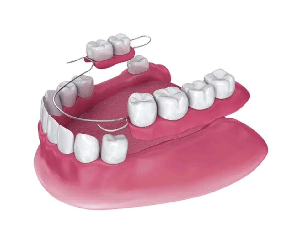 Dentadura parcial