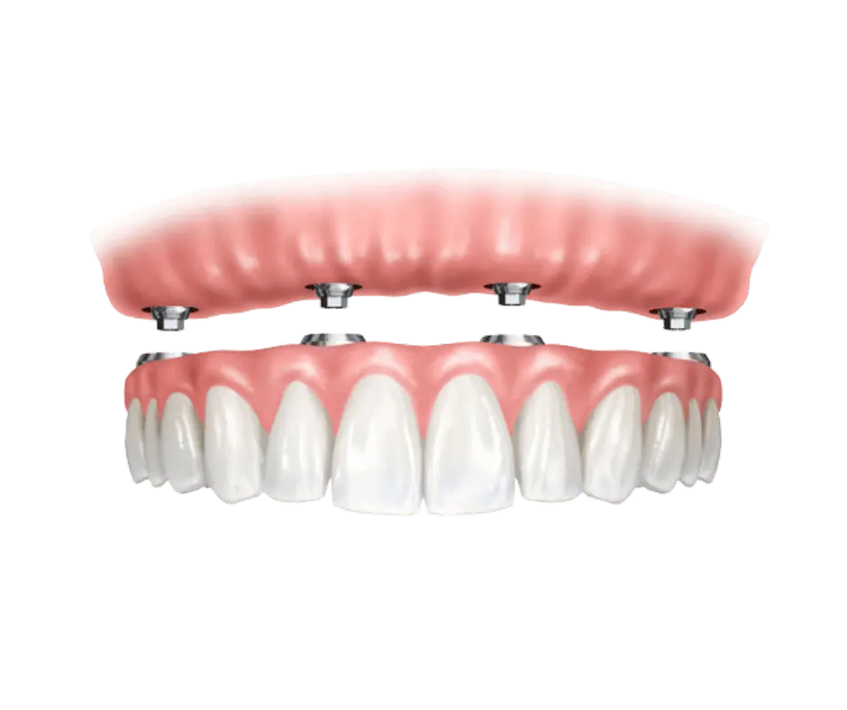Prótesis sobre implantes Dental Zafra