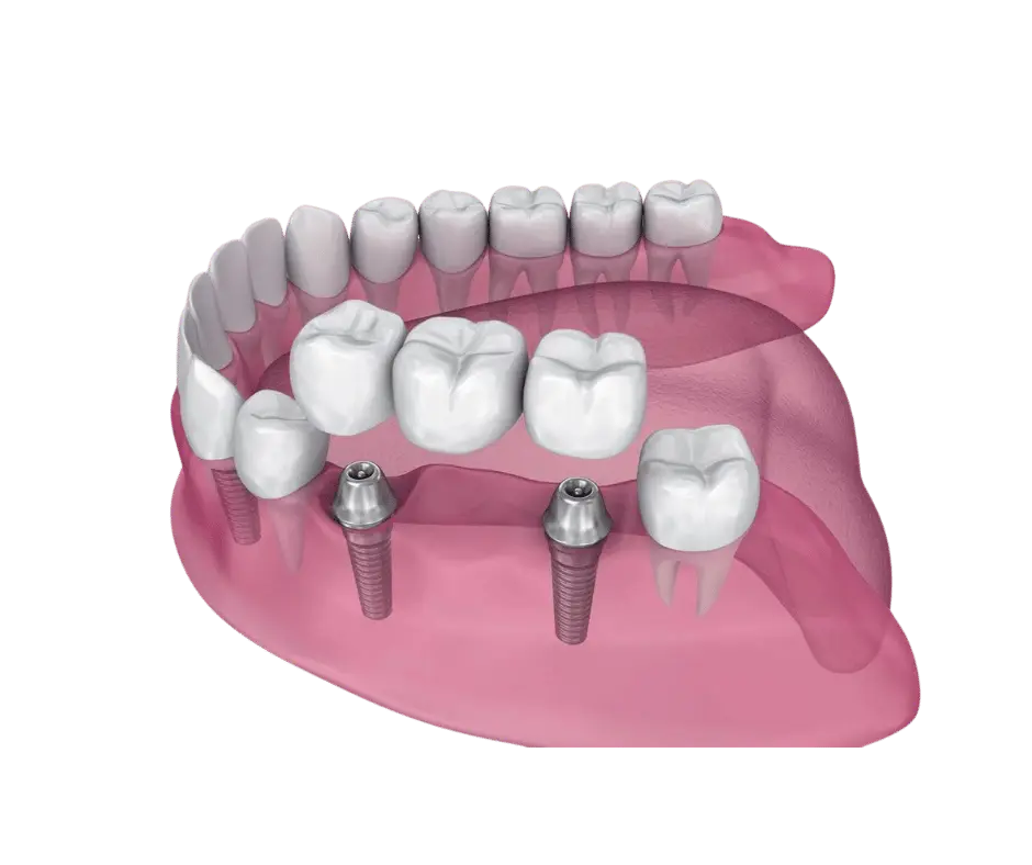Puentes dentales