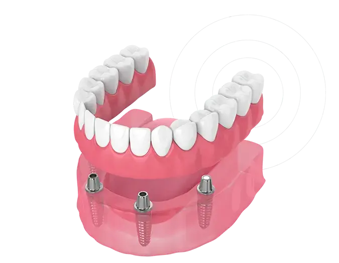 Implante de prótesis dental fija