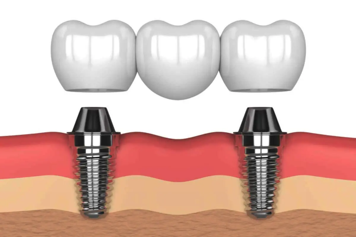 Puente sobre implante dental
