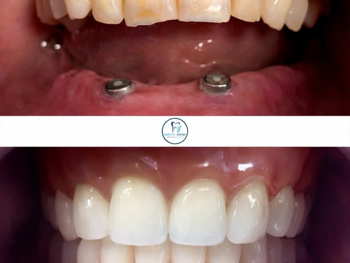 odontologos implantes dentales